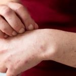 kenali psoriasis penyakit kulit kronis