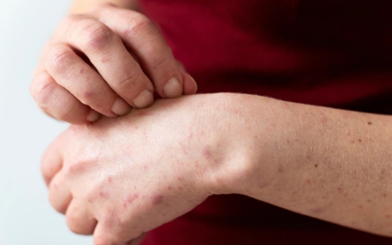 kenali psoriasis penyakit kulit kronis